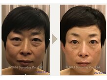 【17か月の結果】いつまでも若々しく！エイジングケアフェイシャル