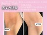 赤ちゃんの頃の色に戻す【ローマピンク】脇　モニター様¥220000→¥132,000