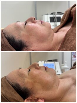 ブリリアント(Brilliant)/フォト美顔