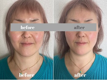 福多整体院/一度でのリフトアップ効果