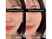 角質ケア/ツヤ肌／毛穴レス/小顔/水光/