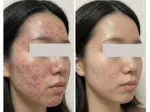 隠すメイクから卒業！繰り返さない根本改善ニキビケア◎