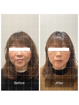 オン鍼灸整体院(ON鍼灸整体院)/美容鍼灸/ビフォーアフター