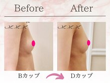 エムエムエム 表参道Luxeサロン(M.M.M)/【バストアップ例】　B→Dカップ