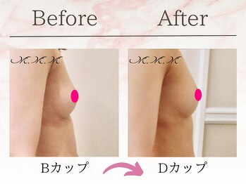 エムエムエム 表参道Luxeサロン(M.M.M)/【バストアップ例】　B→Dカップ