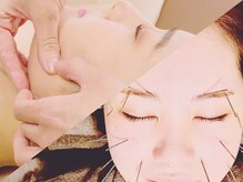 あくび 西麻布(aqu美)/小顔,肌質改善等美容に★美容鍼