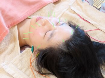 鍼灸院 はりのひとの写真/ハーブピーリング×美容鍼のWアプローチでつるんとたまご肌&ほうれい線・たるみケアにも◎結果に自信☆