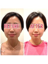 ジェイペック鍼灸整骨院/小顔矯正ビフォアフ