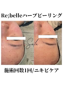 サラ/RE:BELLEハーブピーリング