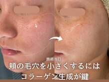 ブルーエム 大森(Blue－M)/頬の毛穴をもっと目立たなく