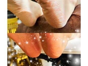 アベビー(Abeby)/冬の踵