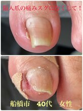 巻き爪じゅん 千葉駅前店/陥入爪のツラさスグになくなる？