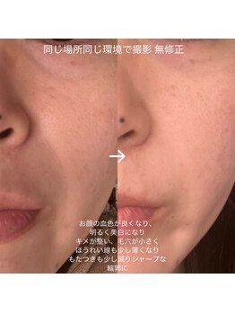 アイビークイーン(I.B.QUEEN)/肌が変わる フェイシャル