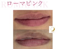 ツキ(TUKI+)/ローマピンク★全身の黒ずみ除去