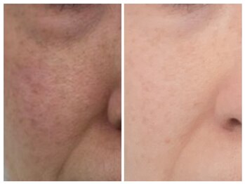 ミヤビ(miyabi)/ルネセル化粧品