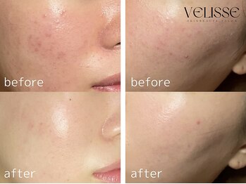 ヴェリス 福岡店(Velisse)/ニキビケア・赤み