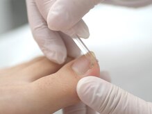 名古屋巻き爪専門Pro/特許取得の巻き爪補正