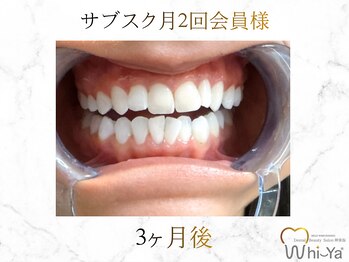 ホワイヤ セルフホワイトニング DBS神楽坂(Whi-Ya)/☆サブスク会員様☆納得の白さ☆