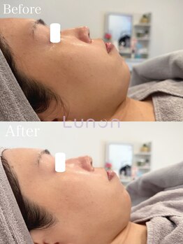 ルノン(Lunon)/毛穴洗浄ハイドロ×ララピール