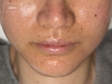 キュレイテッドスキン(CURATED SKIN)/ピーリング/毛穴ケア/肌質改善