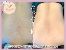 ハーバリー ハーブピーリング 栄(HERBERRYハーブピーリング)/数回でお悩み改善最強ピーリング