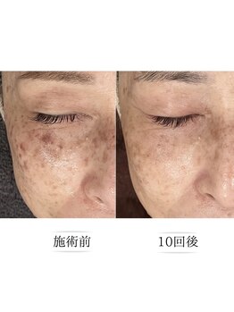 ニコ ウィズ(Nico with)/シミケアプレミアム