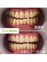ルブラン 奈良店(Le Blanc)/年末までにホワイトニング！