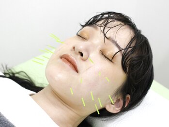 ノモコツ鍼灸 整骨院 よこはまばし院(NOMOKOTSU鍼灸 整骨院)/+…施術風景…+　【美容鍼】