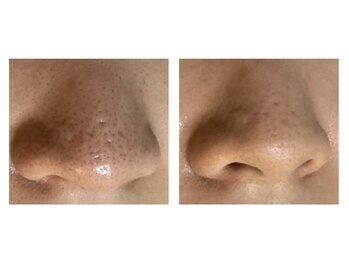 ルシュカ(Rasca)/毛穴が、こんなに綺麗に！1回め