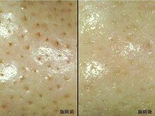 イディオム 広尾(idiom)/毛穴・ニキビケア｜広尾・恵比寿