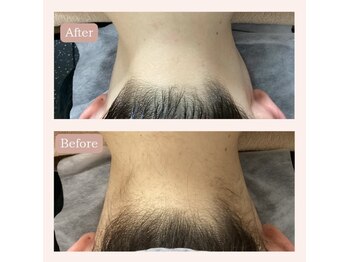 リードエピア(LEADepiA)/成人式前にうなじ脱毛！