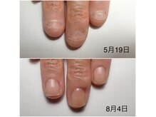 伸び悩んでいた深爪、噛み爪も3ヶ月で見違えるほど変化します
