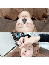 ハリエッセンス(HARI ESSENCE)/毛穴洗浄美容鍼コース