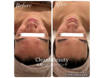 クリーンアンドビューティ 札幌(Clean&Beauty)/DTありハーブピーリング♪