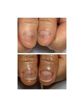 ティアラネイル 宇都宮/深爪矯正