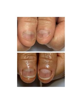 ティアラネイル 宇都宮/深爪矯正