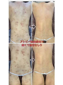 ココティー 大阪店(Cocotii)/背中おしり 5回の変化です