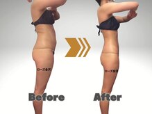 メディカルエステサロン ローズ 金沢本店(ROSE)/痩身ビフォーアフター