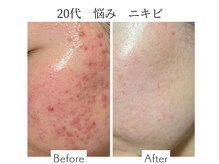 ファニービー 吹田店/20代 ニキビ 10回の施術変化