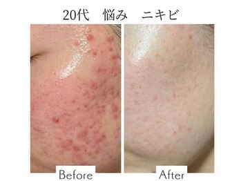 ファニービー 吹田店/20代 ニキビ 10回の施術変化