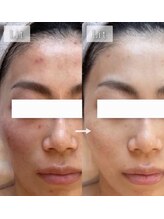 ラボーテエサンテ バイ ティアラ(la beaute et sante by Tiara)/業界初の羊膜幹細胞で炎症ケア