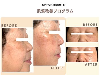 サロンソワ(salon Soi.)/ピュールボーテ：肌質改善