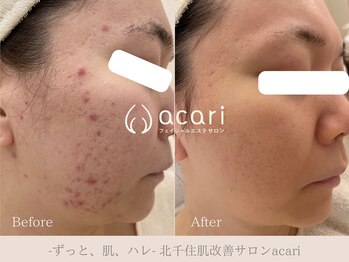 アカリ(acari)の写真/今まで色々と試してきたけど綺麗になれなかった方必見！当店はニキビケアにも自信あり！敏感肌の方にも◎