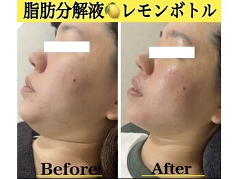 ブレア(Blair)の写真/お顔だけでなく身体にも◎人気沸騰中の【レモンボトル】で脂肪分解＆燃焼！憧れのフェイスラインに♪