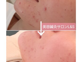 エルアンドエス(L&S)/ニキビケア・肌荒れケア