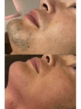 ディサイドロー(DECIDE L.A.W)/男性人気no.1全顔脱毛