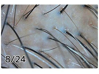 エルール トータルビューティ(Aileure total beauty)/育毛促進ケア　