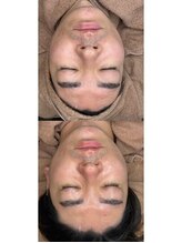 ホワイトアクア つくば店(WHITE AQUA)/ララピール/ つくば/茨城/艶肌