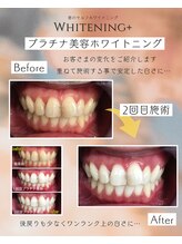 ホワイトニングプラス(Whitening+)/プラチナ美容ホワイトニング