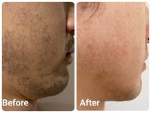 スマイルボディ つぼの森 伊集院店(Smile body)/ ☆メンズ/ひげWAX+光☆